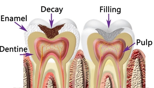 fillings image