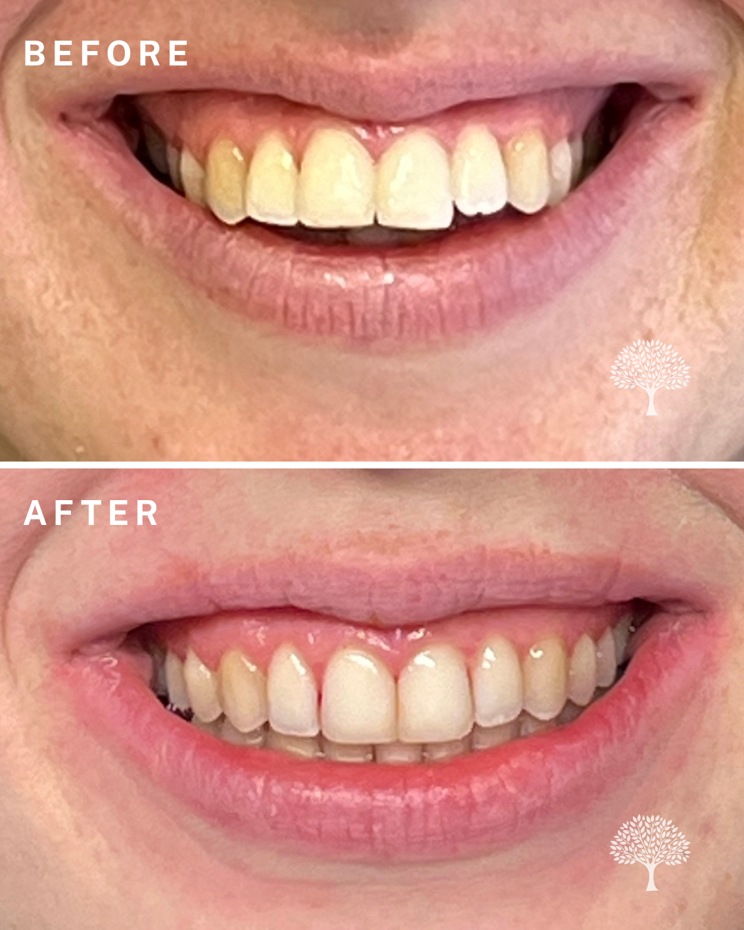 Alice Invisalign-case study with watermark 1