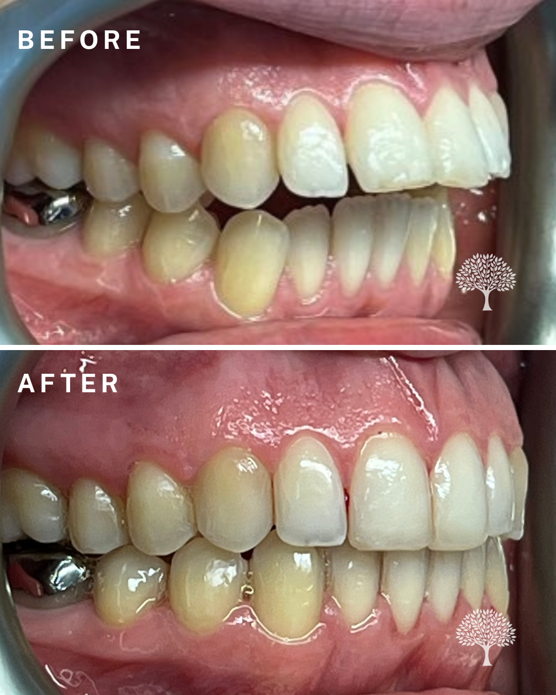 Alice Invisalign-case study with watermark 2