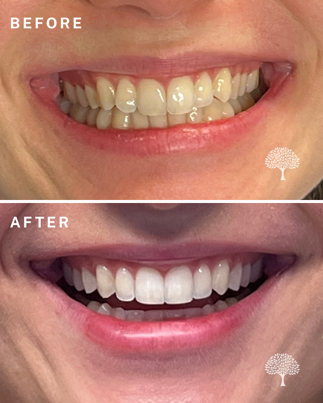 Kailani Invisalign-case study with watermark 1