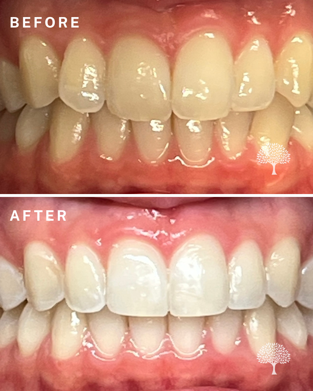 Kailani Invisalign-case study with watermark 2