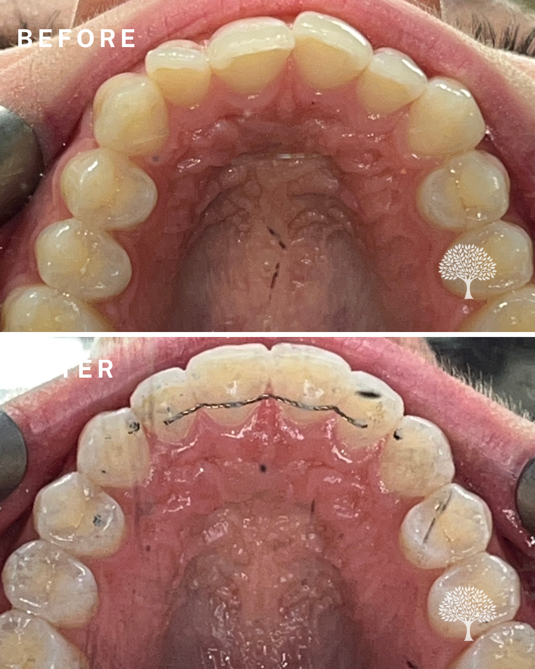Kailani Invisalign-case study with watermark