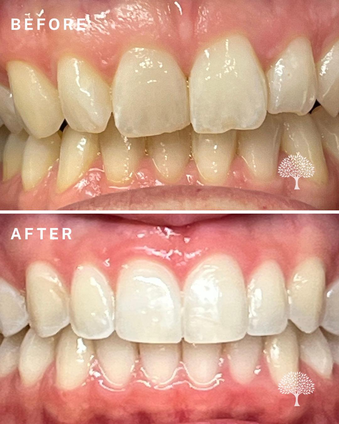 charlotte Invisalign-case study with watermark (1)