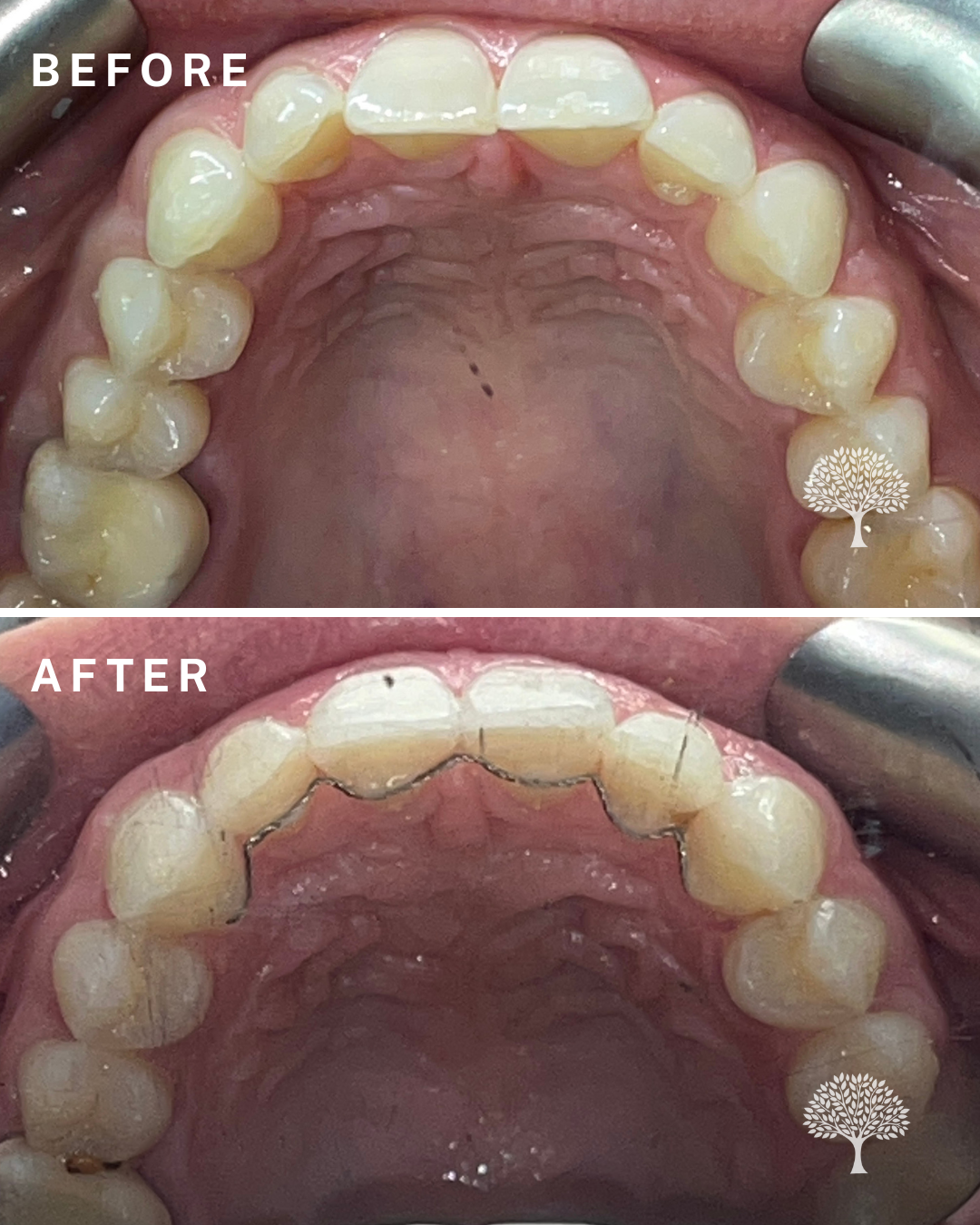 charlotte-Invisalign-case-study-with-watermark-3