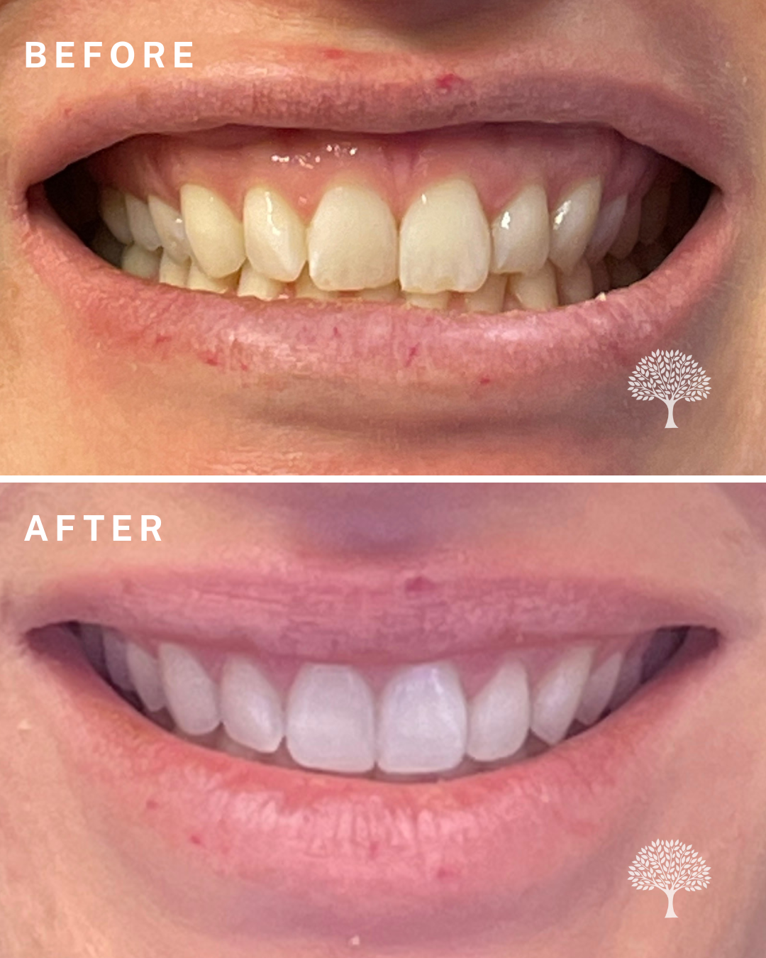 charlotte Invisalign-case study with watermark