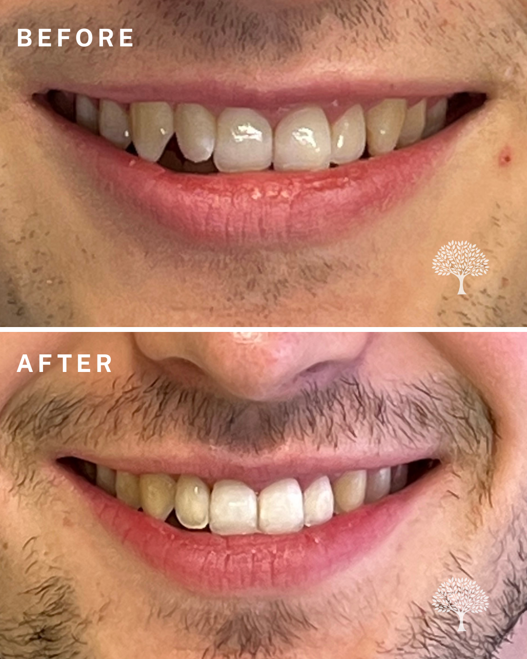 oliver Invisalign case study with watermark 1