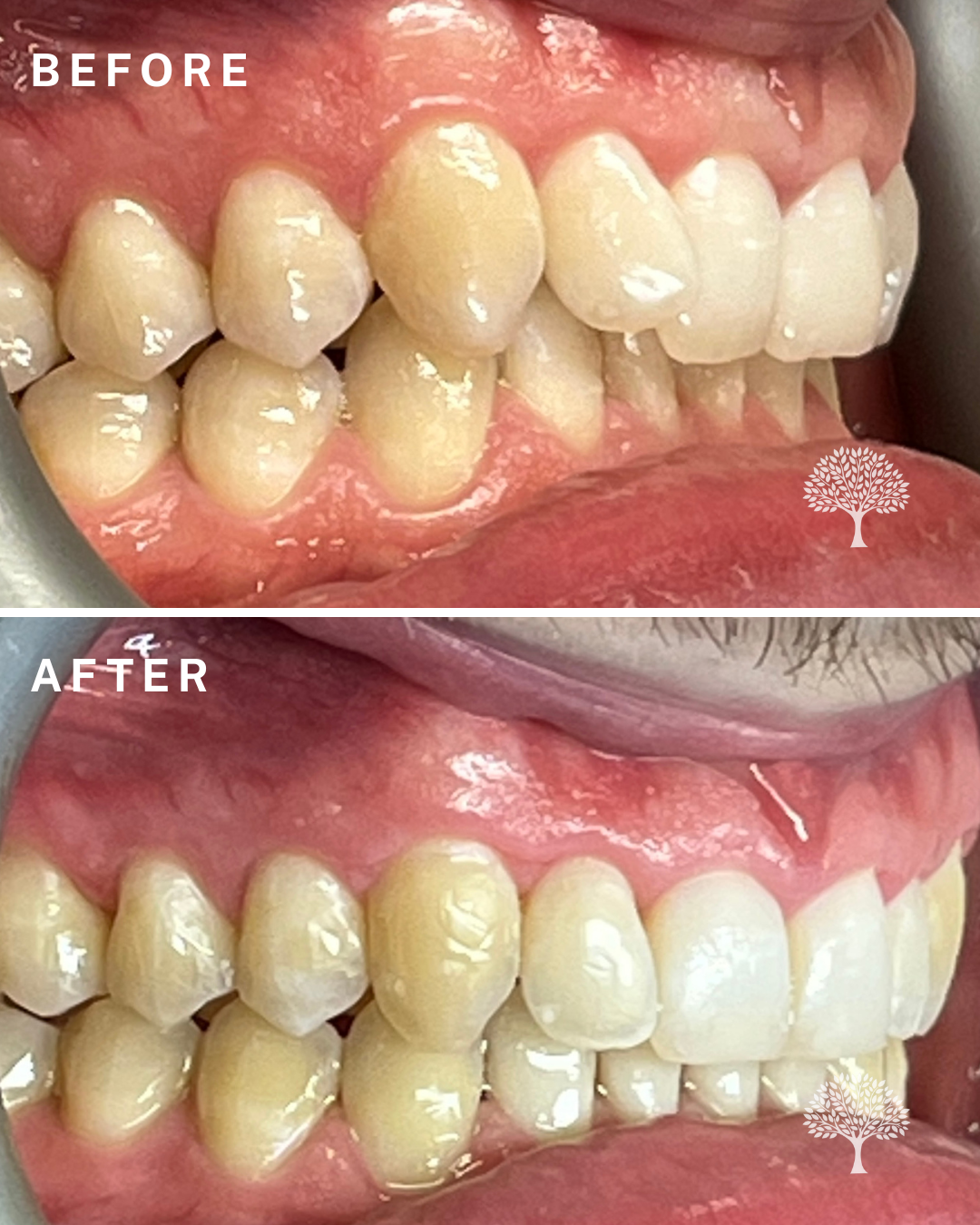 oliver Invisalign case study with watermark 2