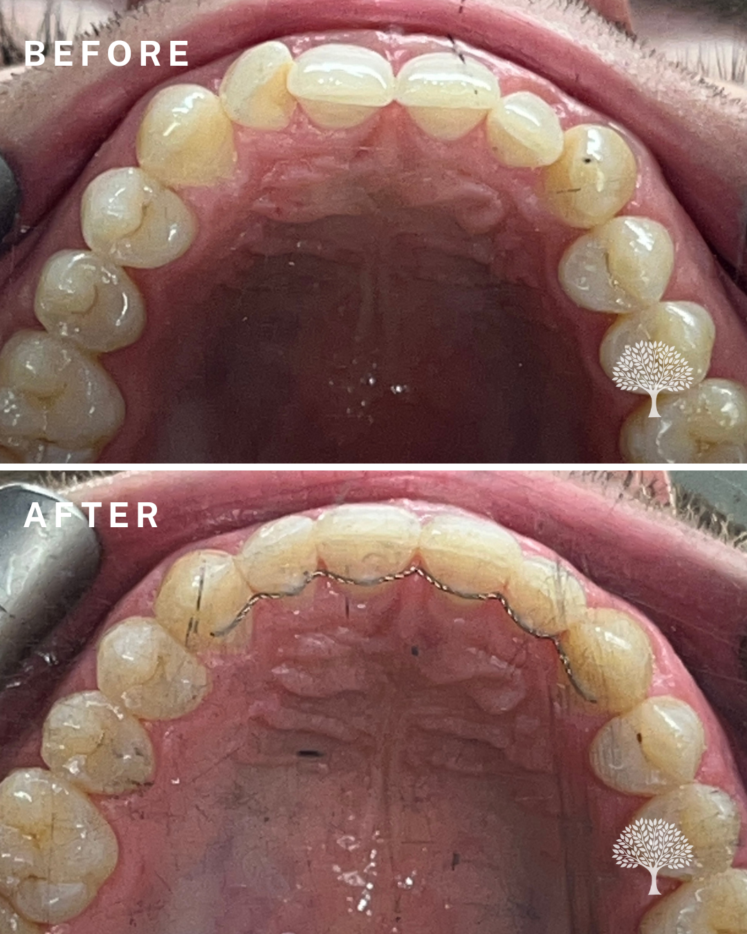 oliver Invisalign case study with watermark 3