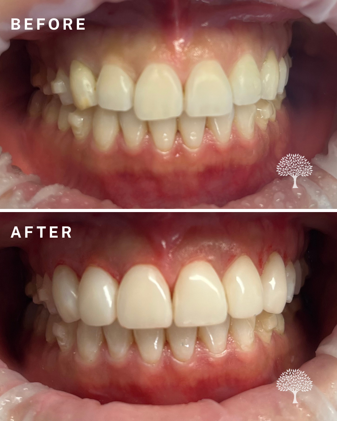 rita-Invisalign-case-study-with-watermark-2 (1)