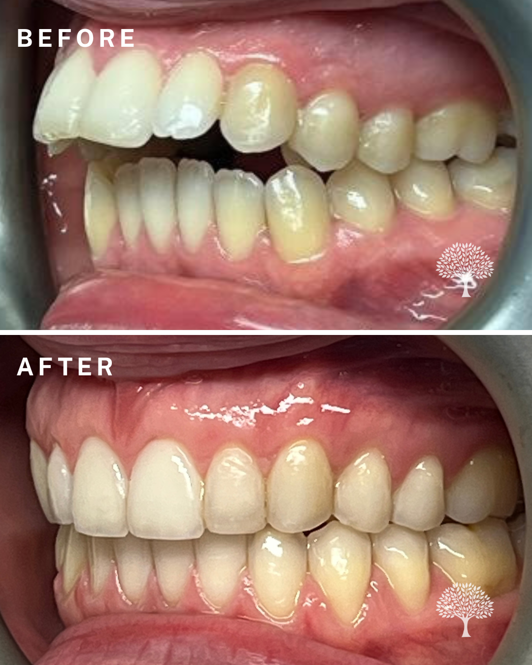 sabrina-Invisalign-case-study-with-watermark-2